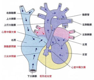 三尖弁閉鎖症 | RareS.(レアズ)