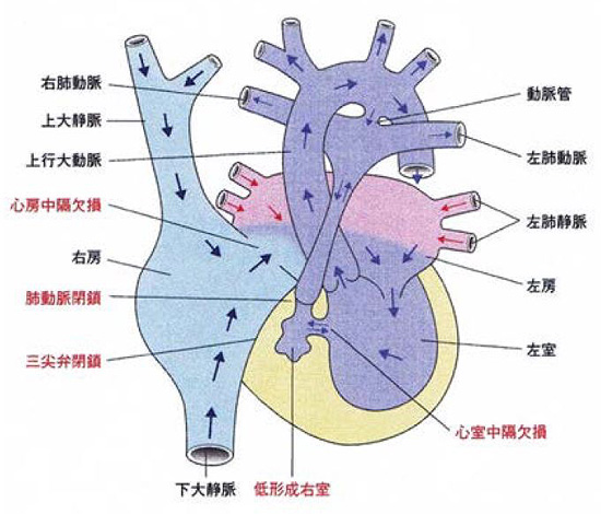 三尖弁